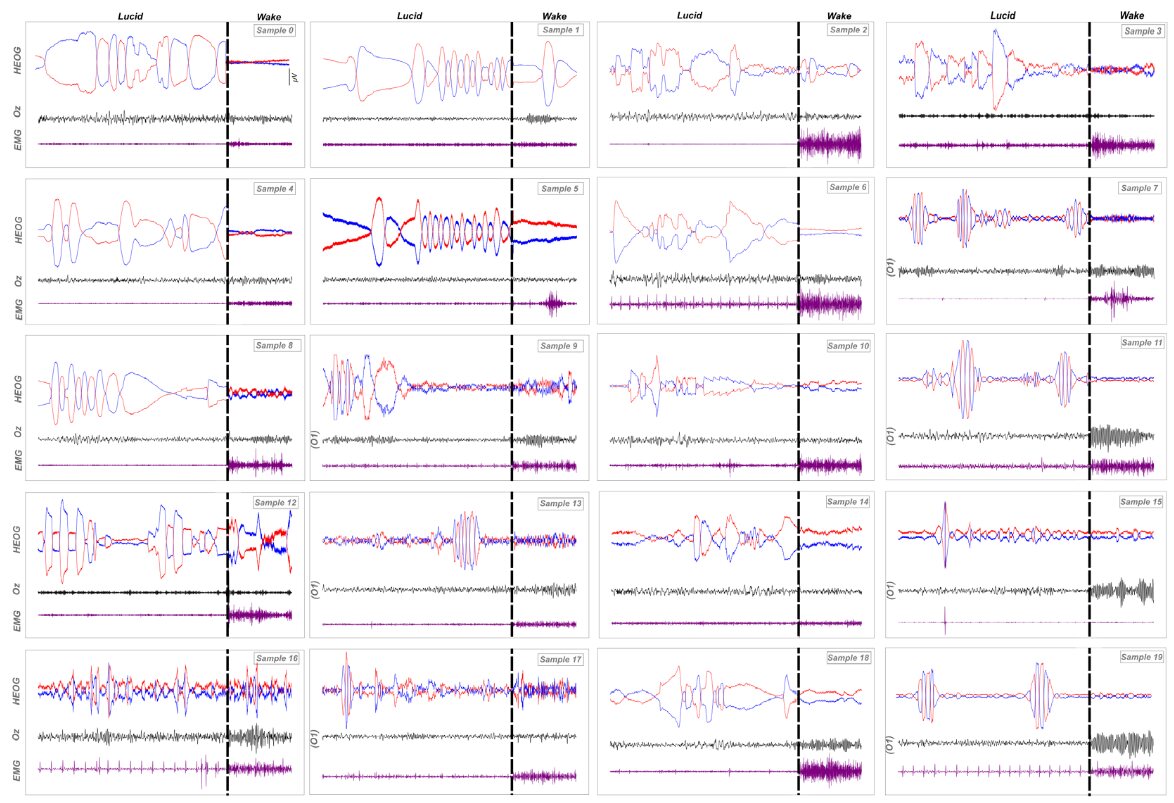 Electrophysiological Correlates